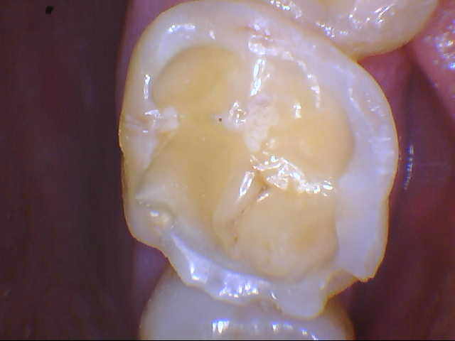 bulimia and yellow teeth