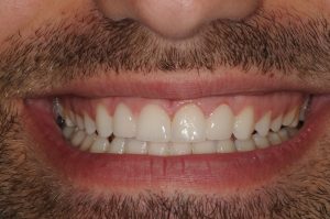 Dents après traitement 