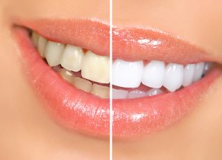 dents avant-après blanchiment dentaire