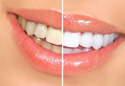 dents avant-après blanchiment dentaire
