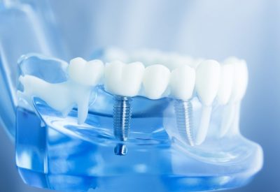 Des implants dentaires sur un modèle
