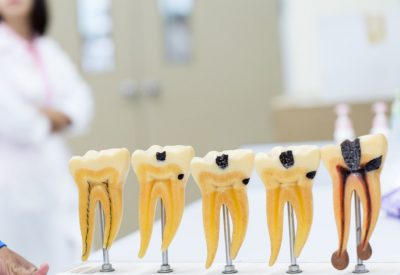 Le traitement de canal en 4 questions | Prisma Dentistes