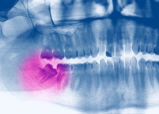 Comprendre l’extraction des dents de sagesse