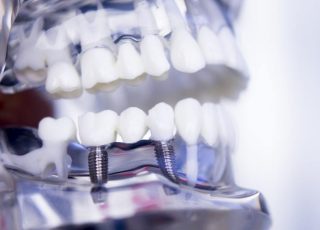Les implants dentaires pour remplacer les dents manquantes