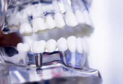 Les implants dentaires pour remplacer les dents manquantes