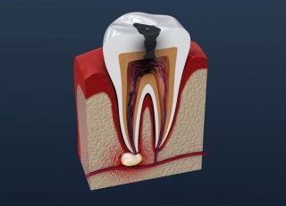 Qu’est-ce qu’un abcès dentaire ?