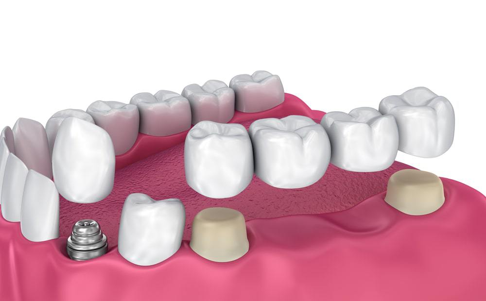 Qu'est-ce qu'une restauration dentaire ?