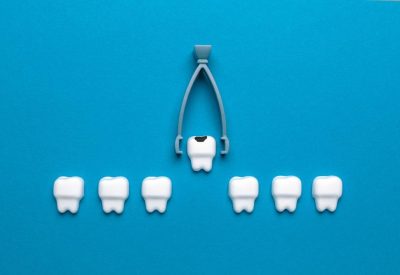 Extraction dentaire : questions fréquentes & réponses