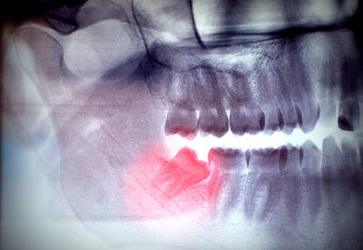 Dents de sagesse : les risques de complications