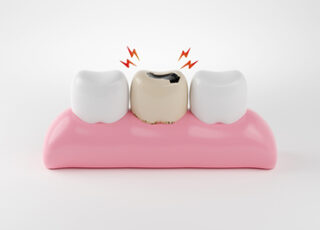 Comment la carie dentaire évolue-t-elle ?