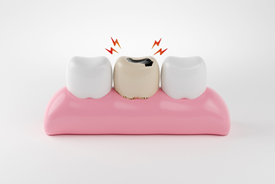Comment la carie dentaire évolue-t-elle ?